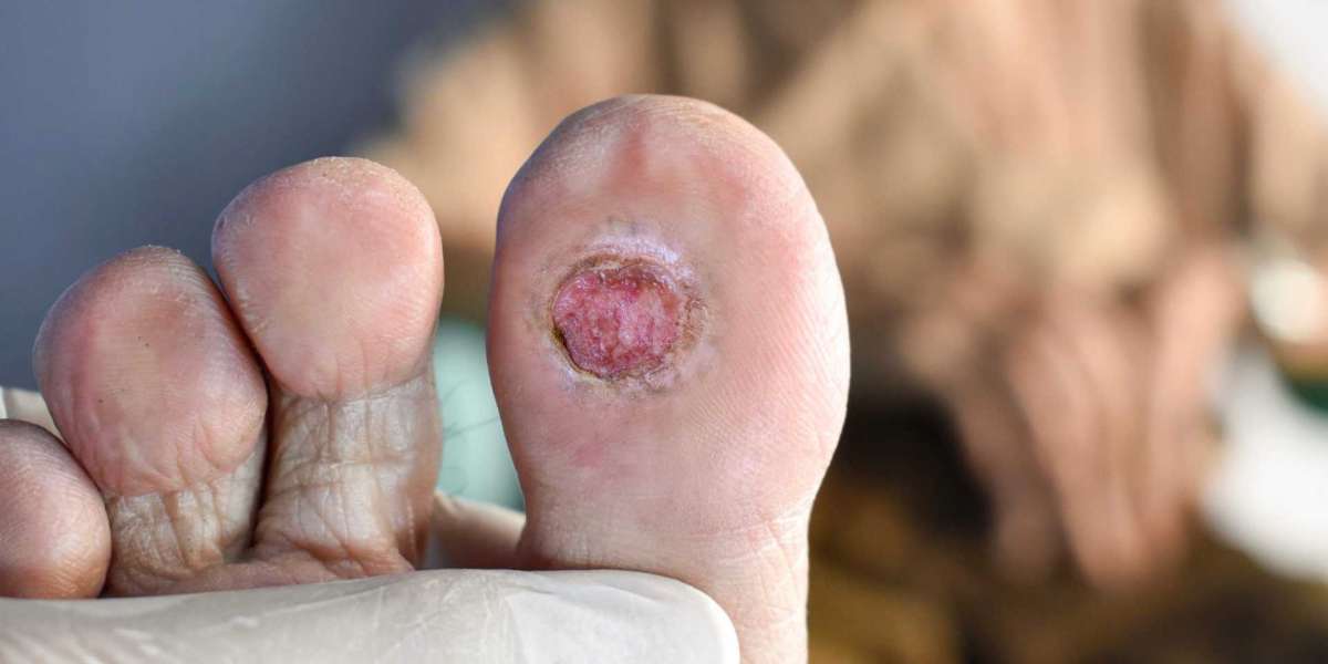 Diabetic Foot Ulcers Market: A USD 10.5 Billion Industry by 2032