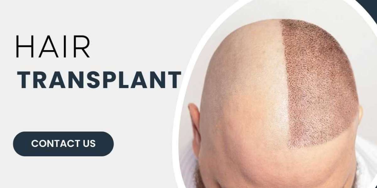 Is Hair Transplant a Permanent Solution for Hair Loss?