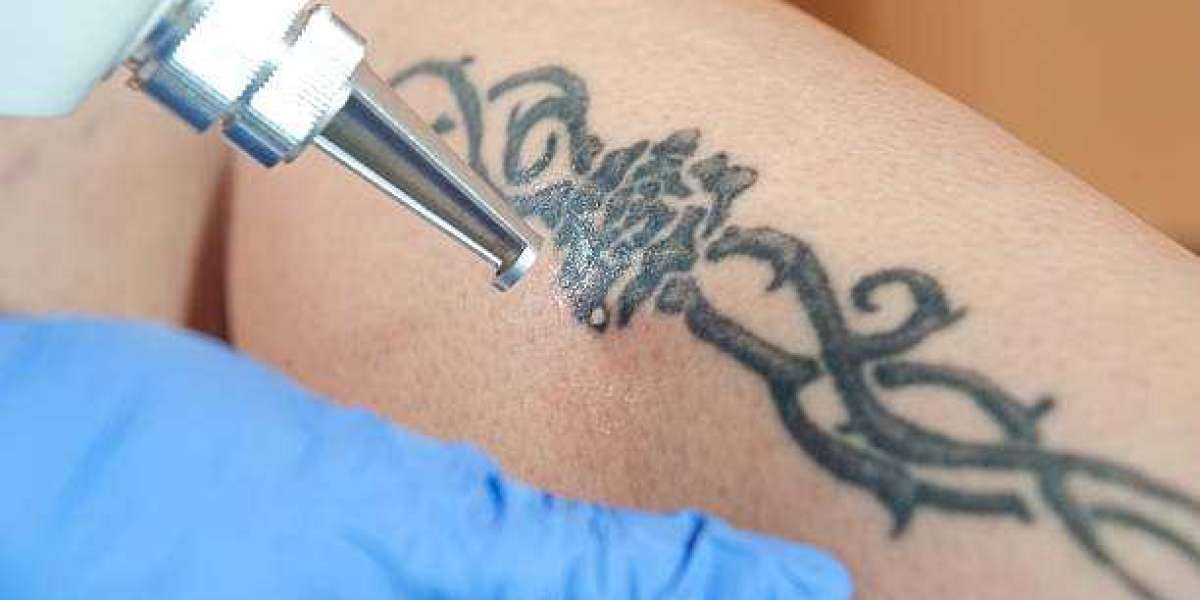 Discover the Benefits of Tattoo Removal Paper in Riyadh