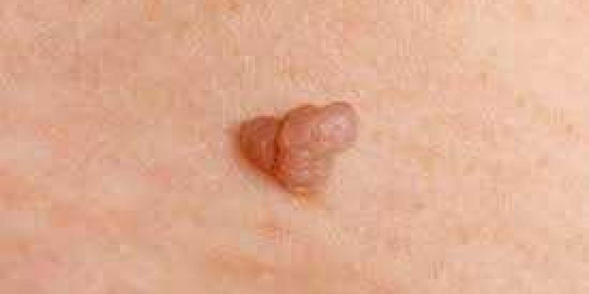 Pain-Free Skin Tag Removal Treatments