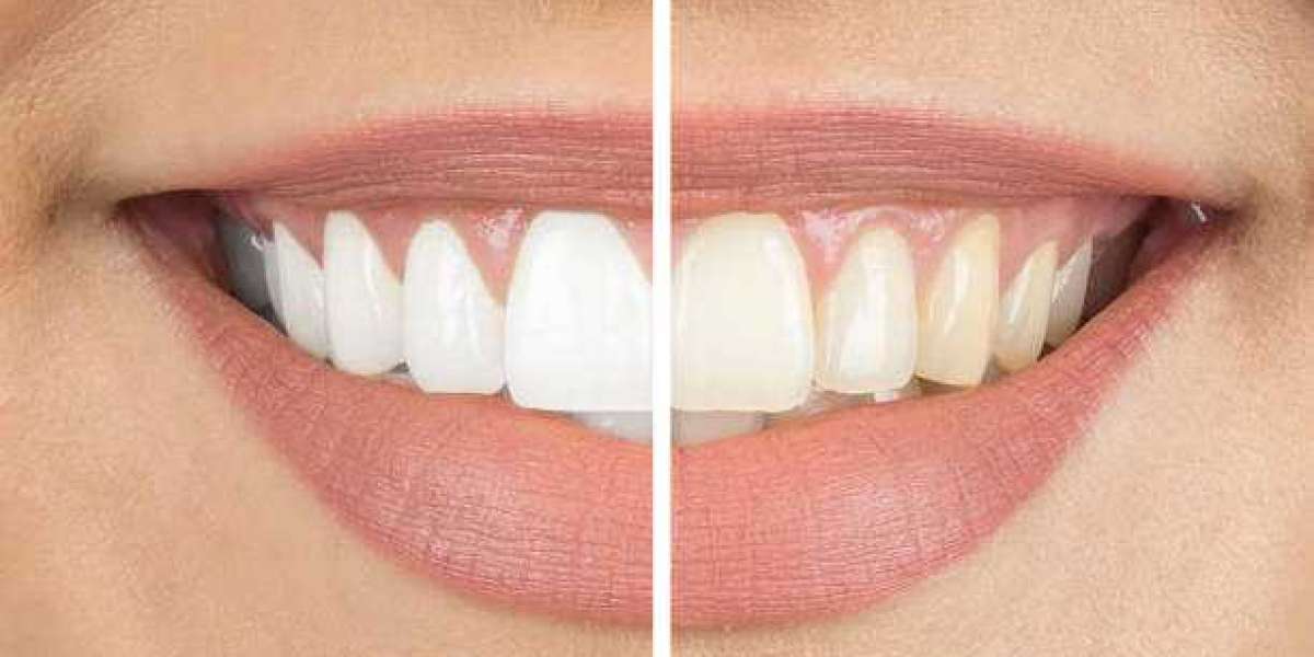 Safe and Effective Teeth Whitening in Riyadh