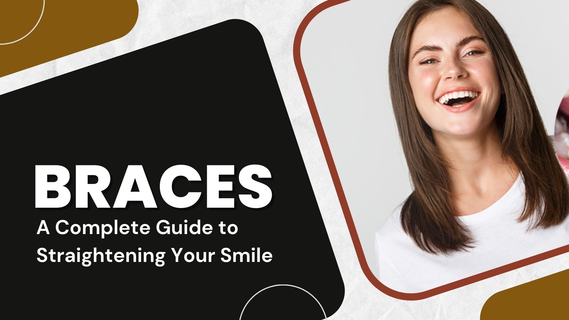 Braces: A Complete Guide to Straightening Your Smile