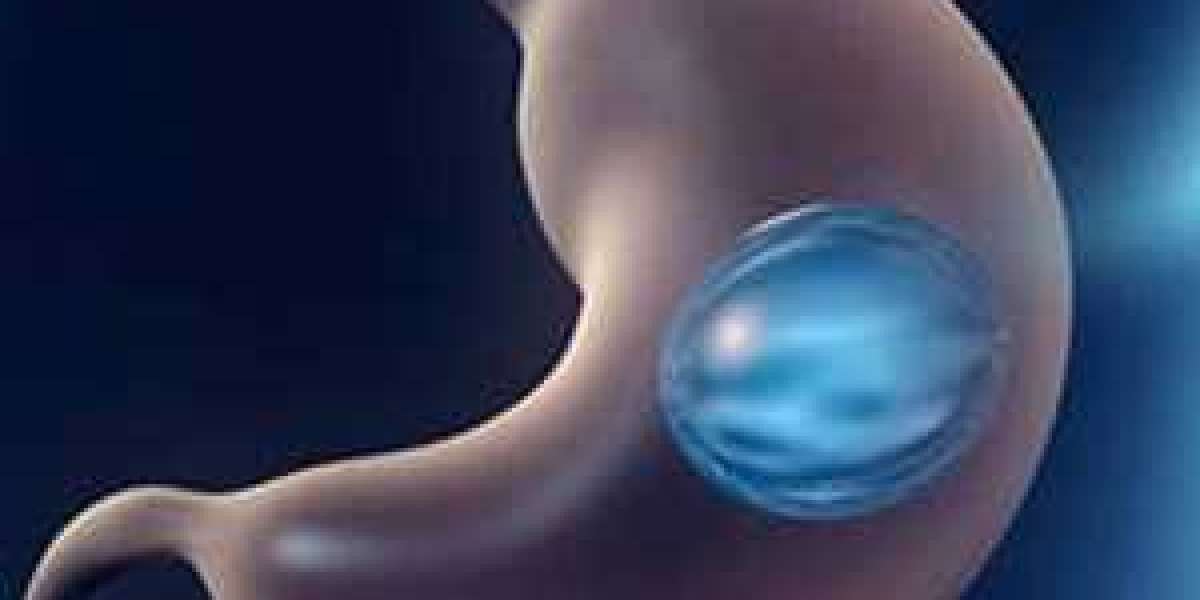 Your Guide to Gastric Balloon in Riyadh